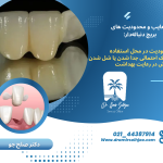 بریج دنباله دار