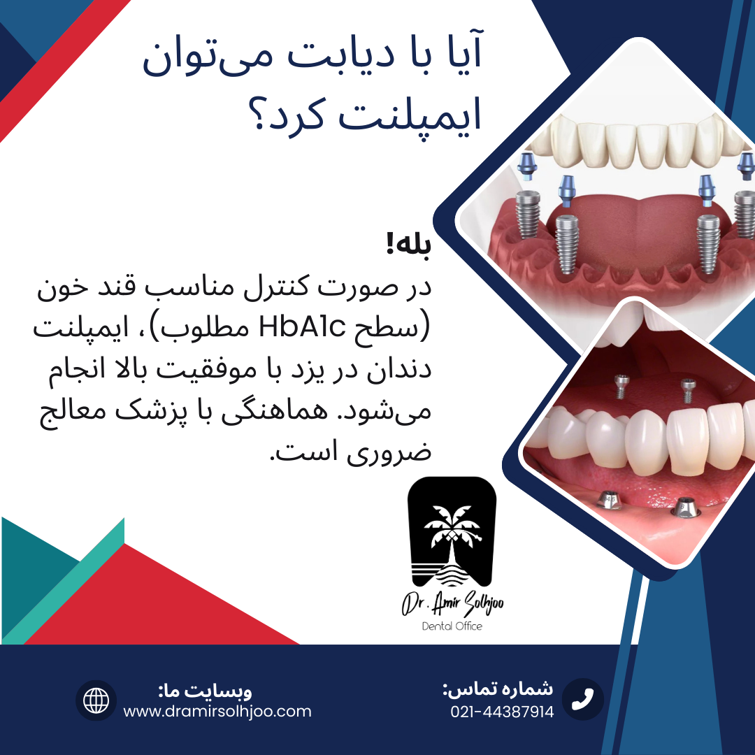 ایمپلنت دندان در یزد