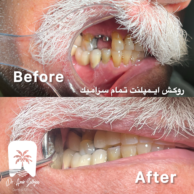 روکش ایمپلنت تمام سرامیک