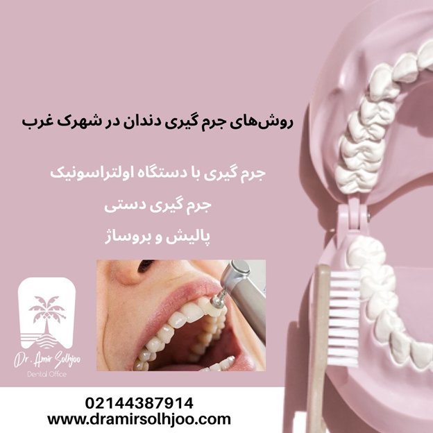 جرم گیری دندان در شهرک غرب