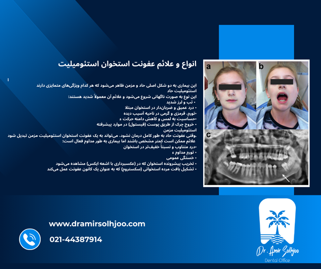 عفونت استخوان استئومیلیت