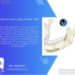 جوش خوردن فک بعد از جراحی