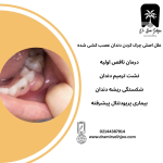 چرک کردن دندان عصب کشی شده