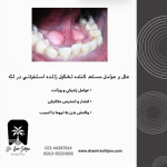 زائده استخوانی در لثه