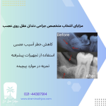 متخصص جراحی دندان عقل روی عصب