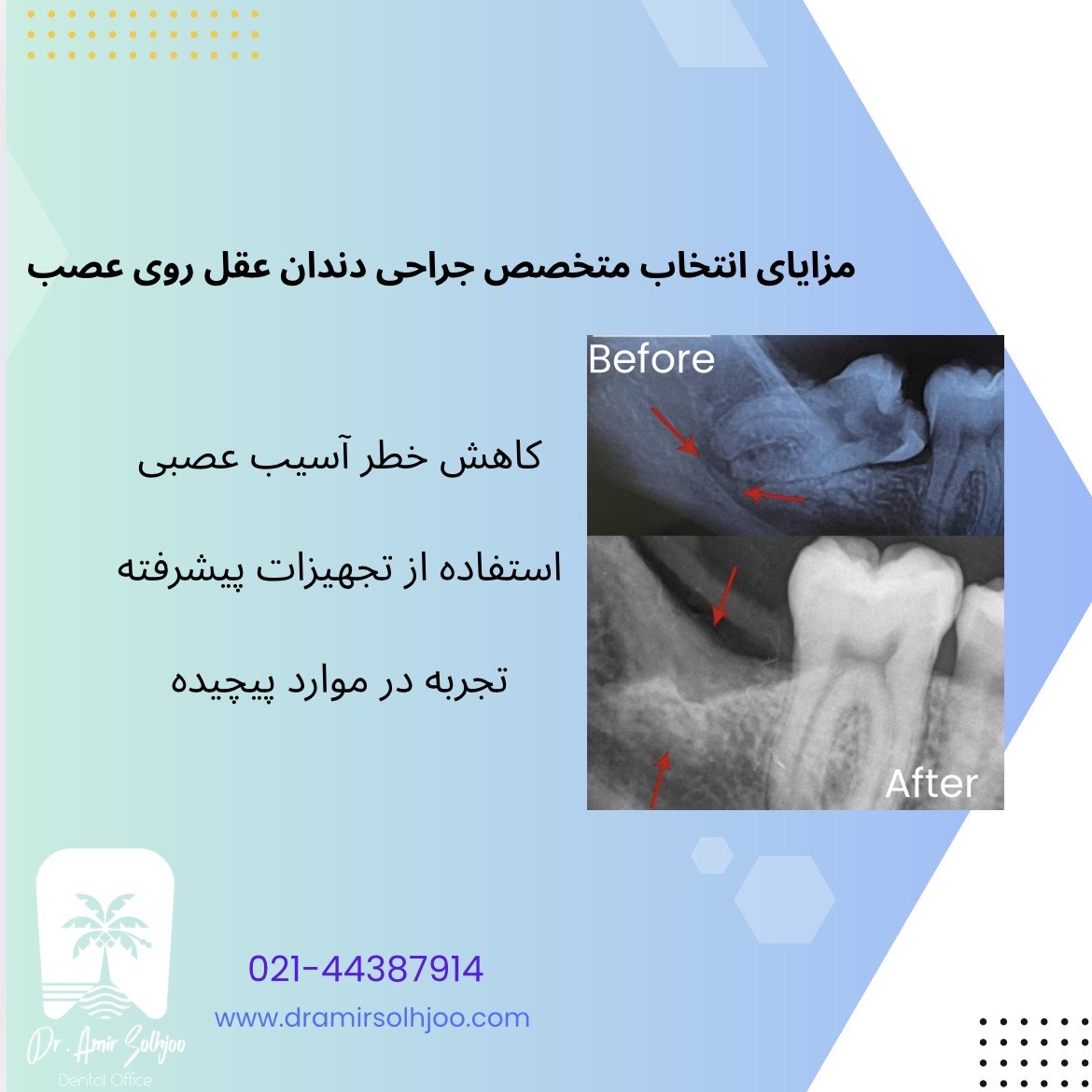 متخصص جراحی دندان عقل روی عصب