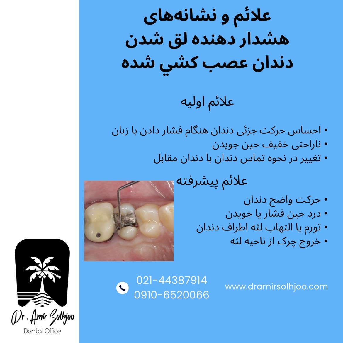 لق شدن دندان عصب کشی شده