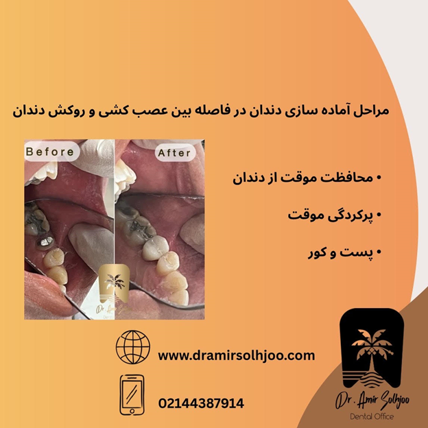 فاصله بین عصب کشی و روکش دندان | راهنمای کامل زمانبندی صحیح