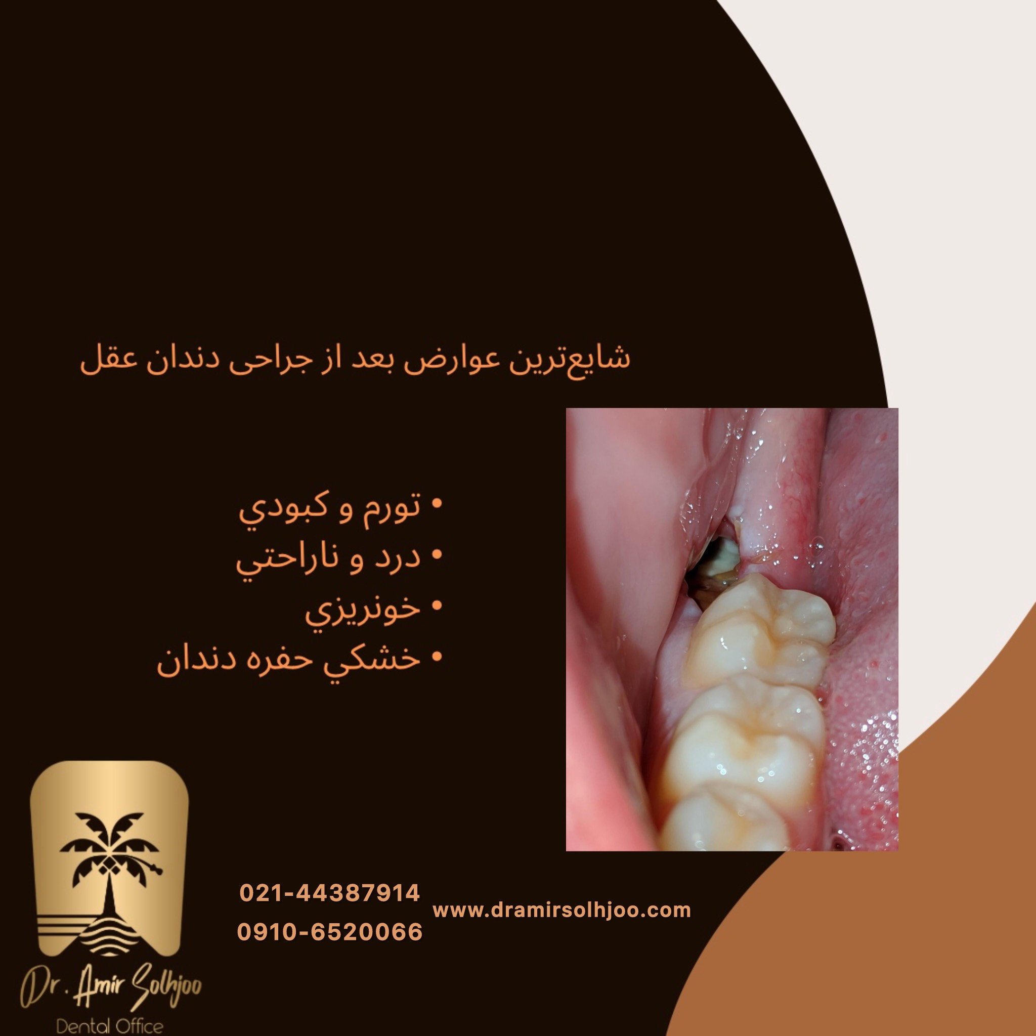 عوارض بعد از جراحی دندان عقل