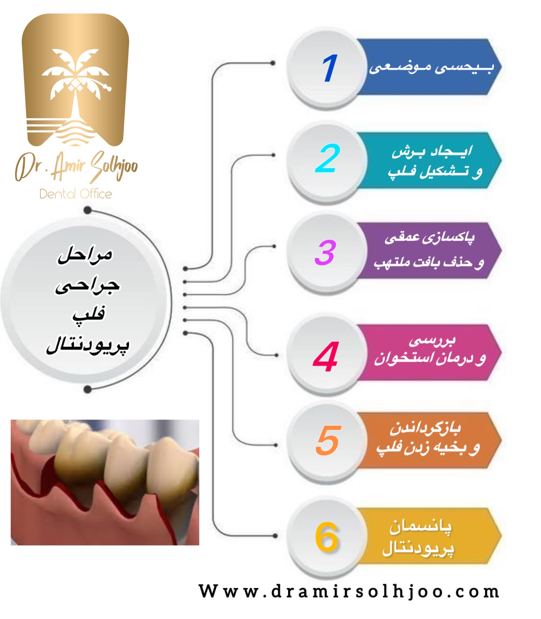 جراحی فلپ پریودنتال