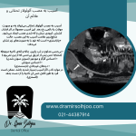 عصب آلوئولار تحتانی