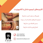 ترمیم دندان با کامپوزیت در مرزداران