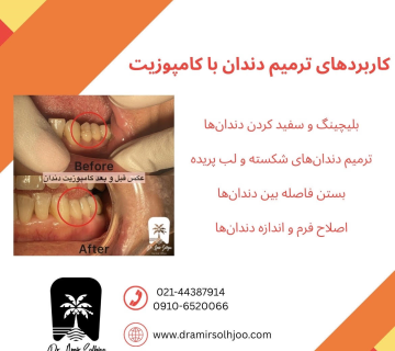 ترمیم دندان با کامپوزیت در مرزداران