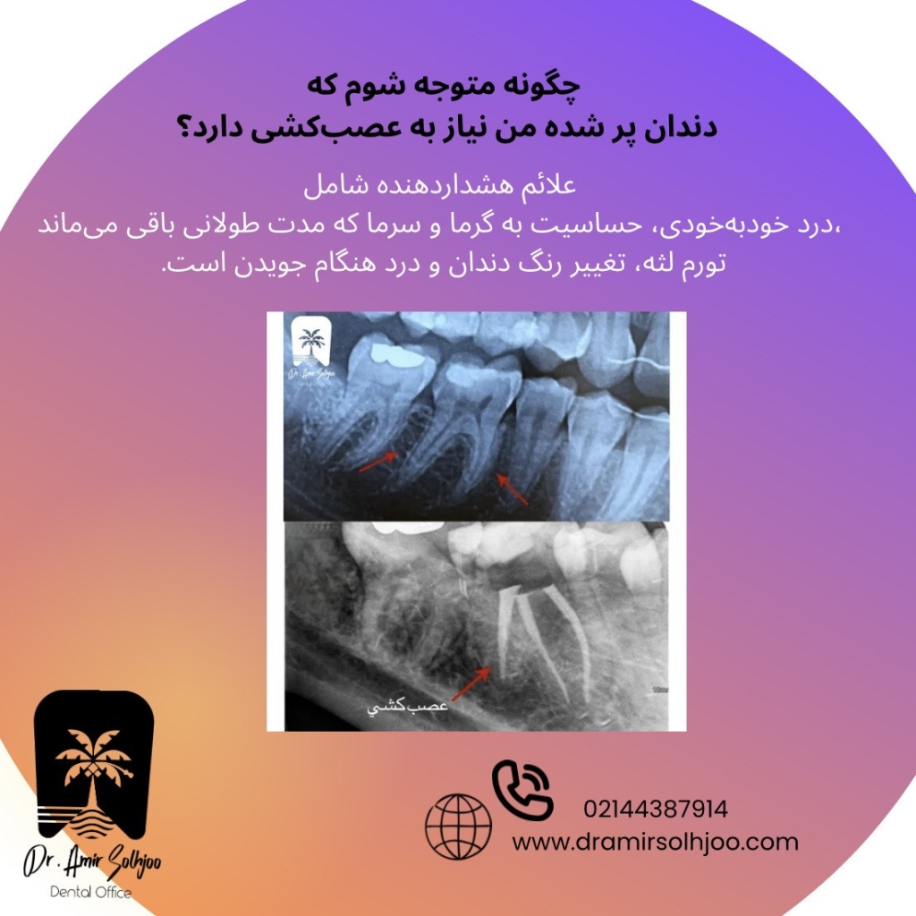 عصبکشی دندان پر شده