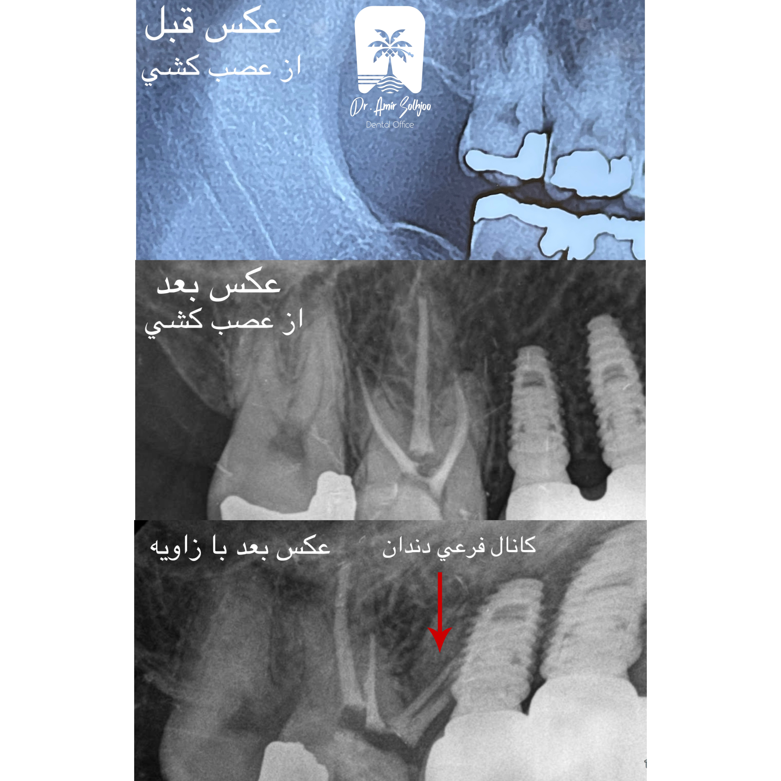 عصبکشی دندان پر شده