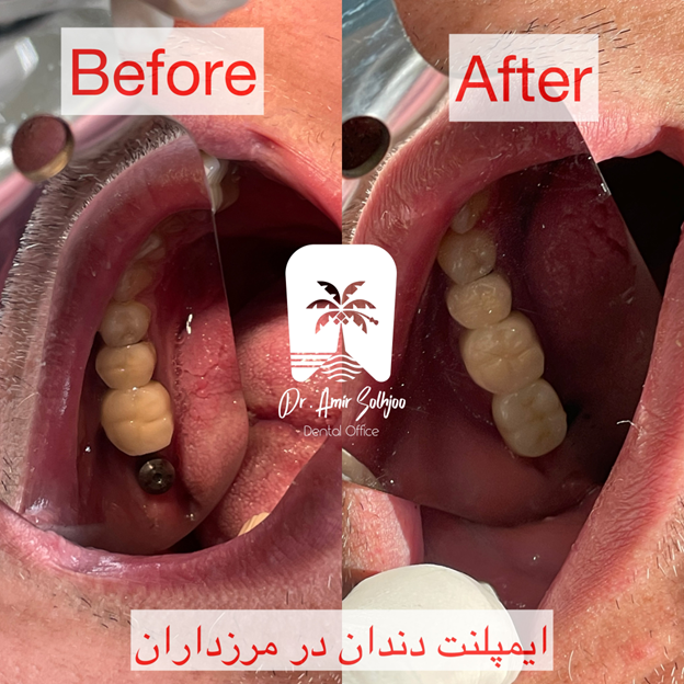 عکس قبل و بعد ایمپلنت zirconia