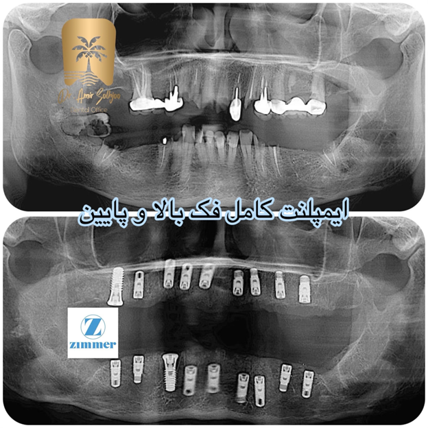ایمپلنت کامل فک بالا و پایین