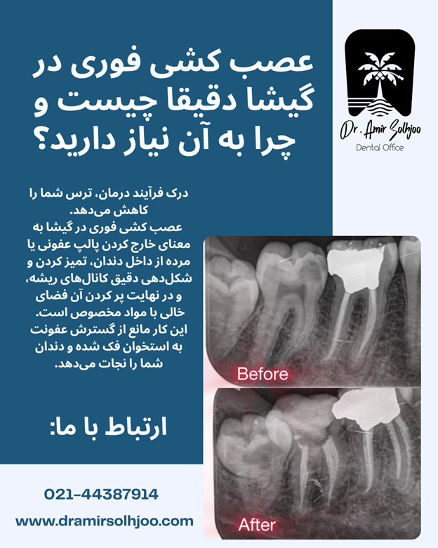 عصب کشی فوری در گیشا