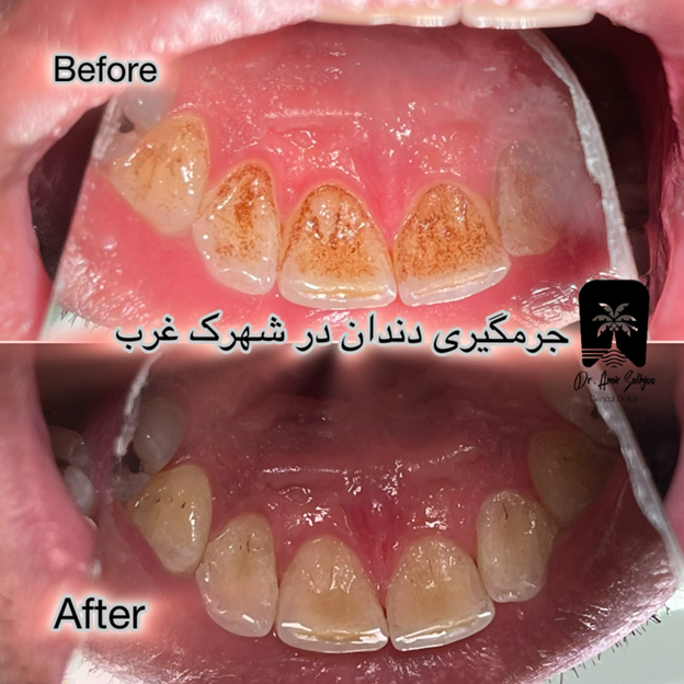 جرم گیری دندان در شهرک غرب