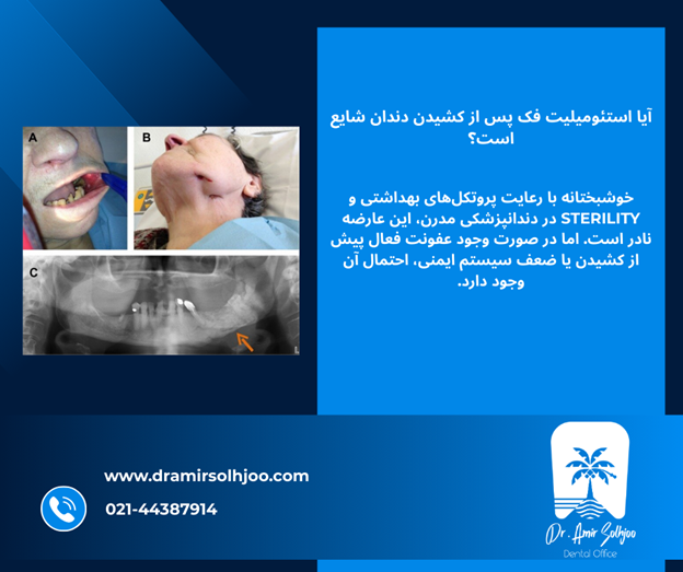عفونت استخوان استئومیلیت