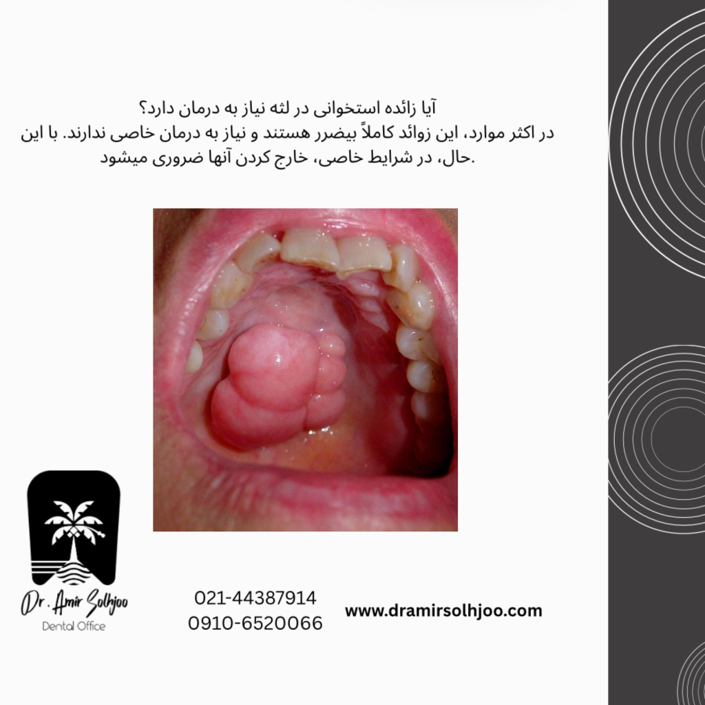 زائده استخوانی در لثه