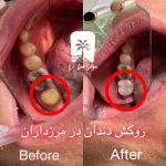 قیمت روکش زیرکونیا در مرزداران