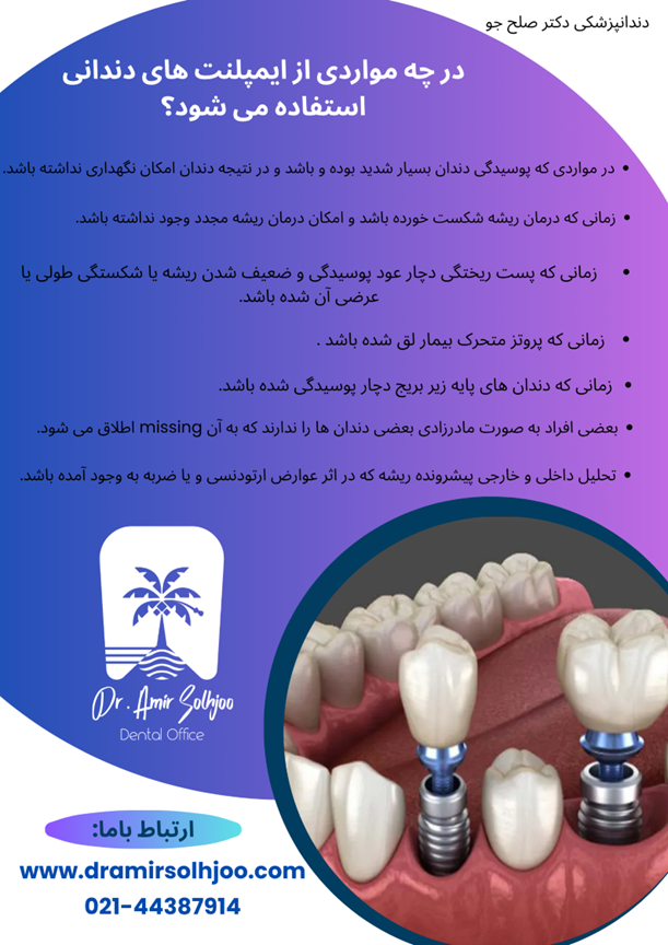 ایمپلنت دندان