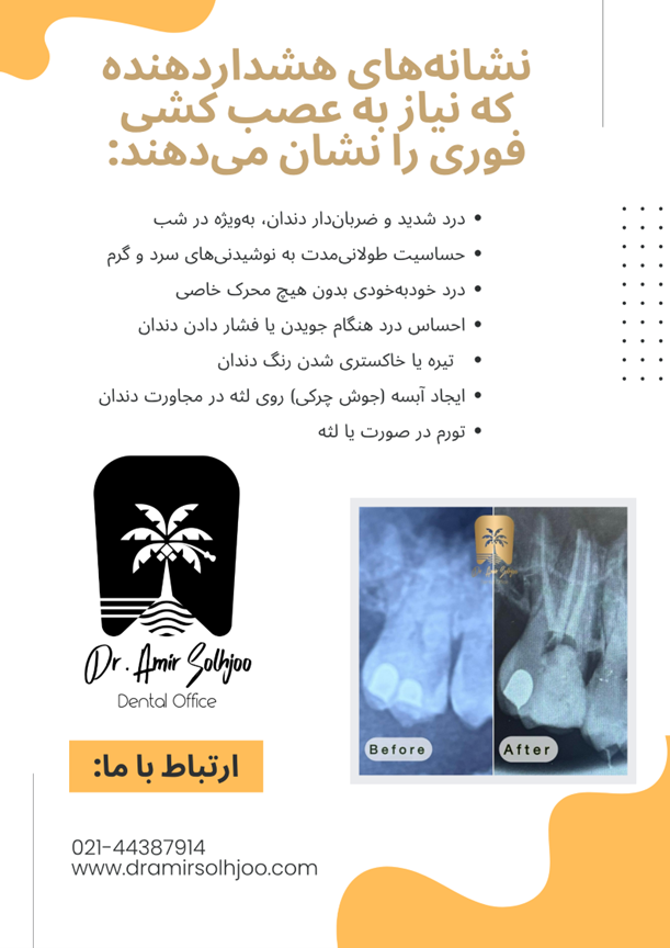 عصب کشی فوری در گیشا