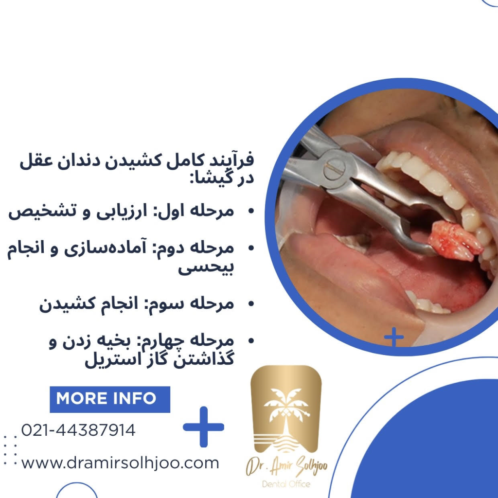کشیدن دندان عقل در گیشا