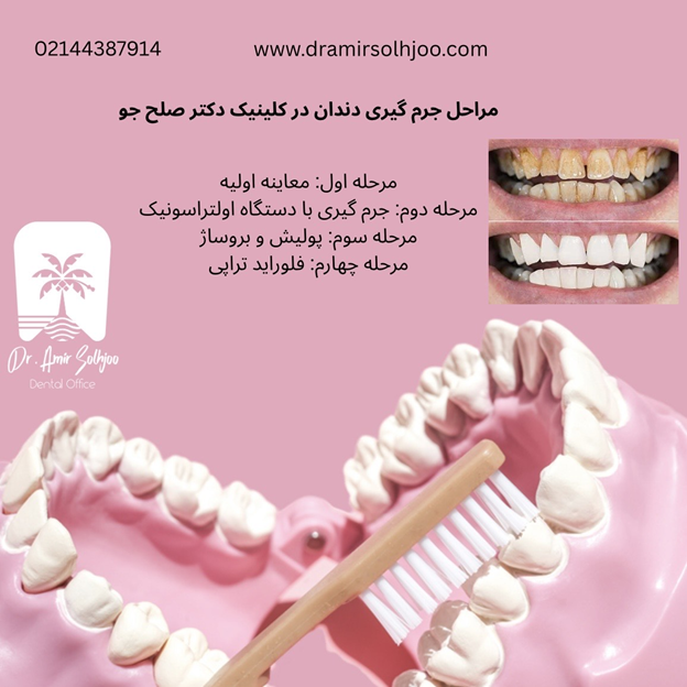 بهترین مرکز جرم گیری دندان در گیشا