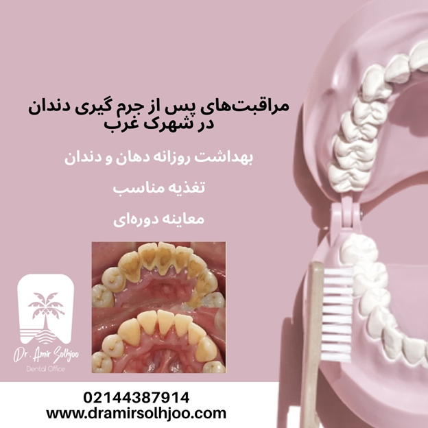 جرم گیری دندان در شهرک غرب