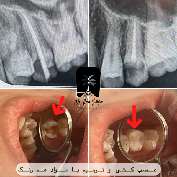عصبکشی در تهران