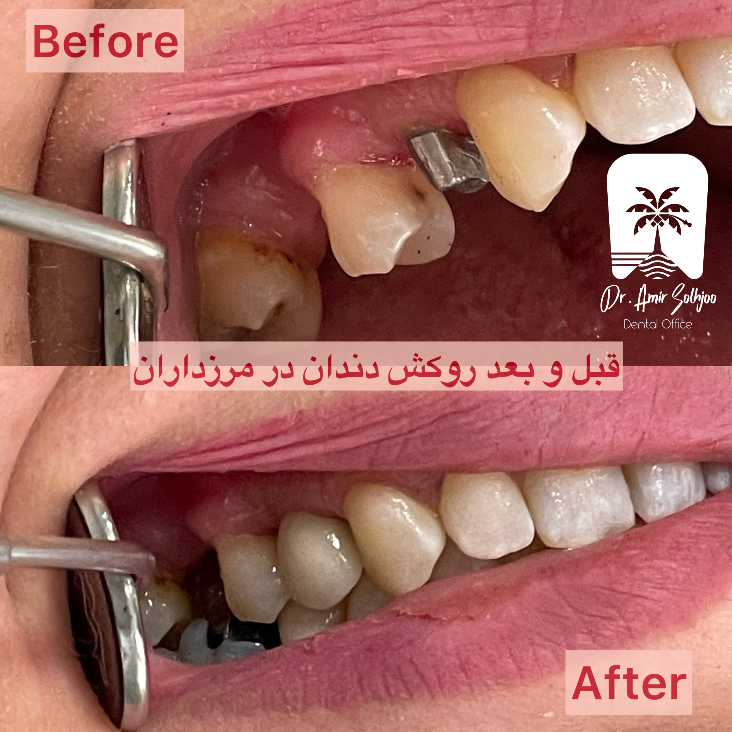 پروتزهای متحرک و ثابت