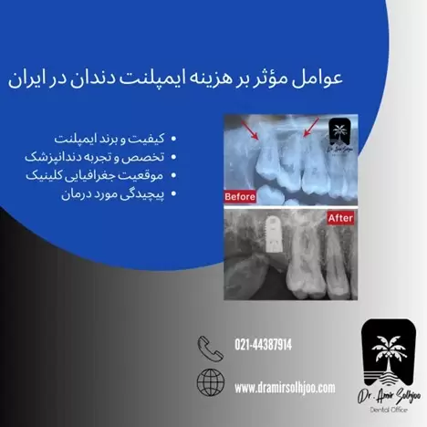 بهترین نوع پیچ ایمپلنت دندان