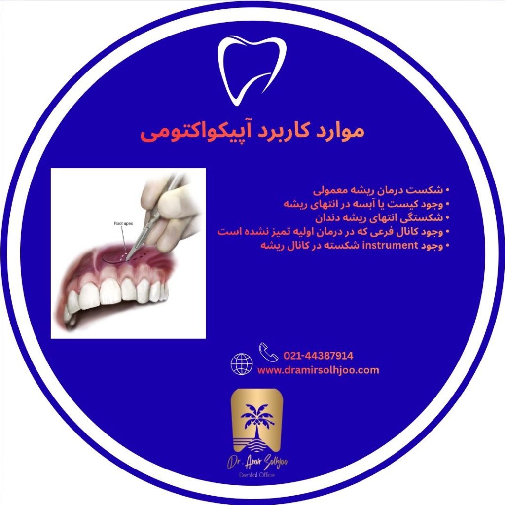 آپیکواکتومی