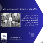 روش جدید پرکردن دندان بدون عصب کشی