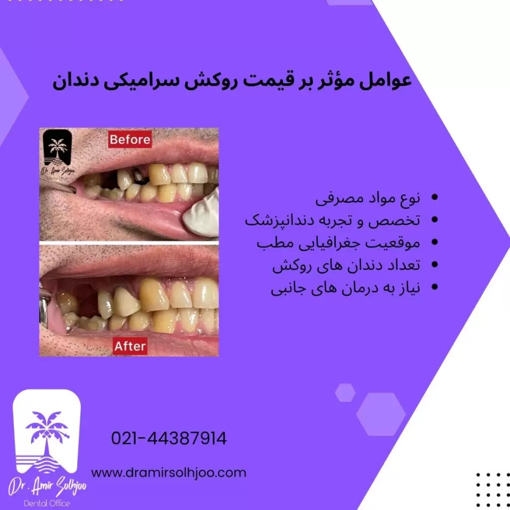 قیمت روکش سرامیکی دندان
