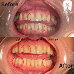 ترمیم دندان با کامپوزیت