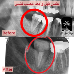 بهترین دکتر عصب کشی در قیطریه
