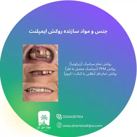 هزینه روکش ایمپلنت