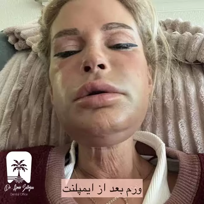 ورم بعد از ایمپلنت