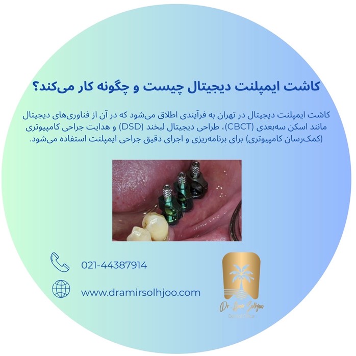 کاشت ایمپلنت دیجیتال در غرب تهران