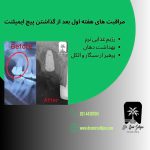مراقبت های بعد از گذاشتن پیچ ایمپلنت