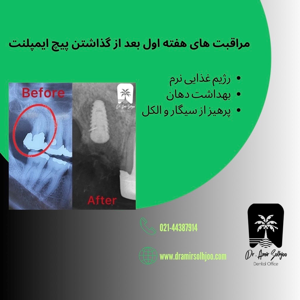 مراقبت های بعد از گذاشتن پیچ ایمپلنت