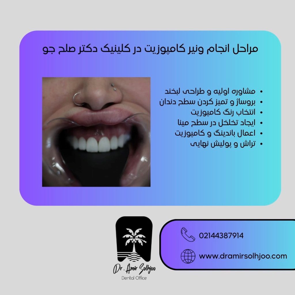 مراحل انجام ونیر کامپوزیت در کلینیک دکتر صلح جو
