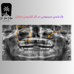 باز شدن سینوس در اثر کشیدن دندان