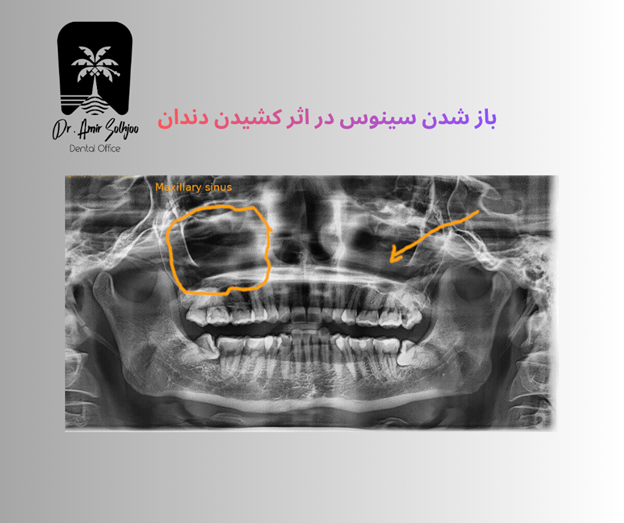 باز شدن سینوس در اثر کشیدن دندان