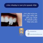 لومینیرز دندان