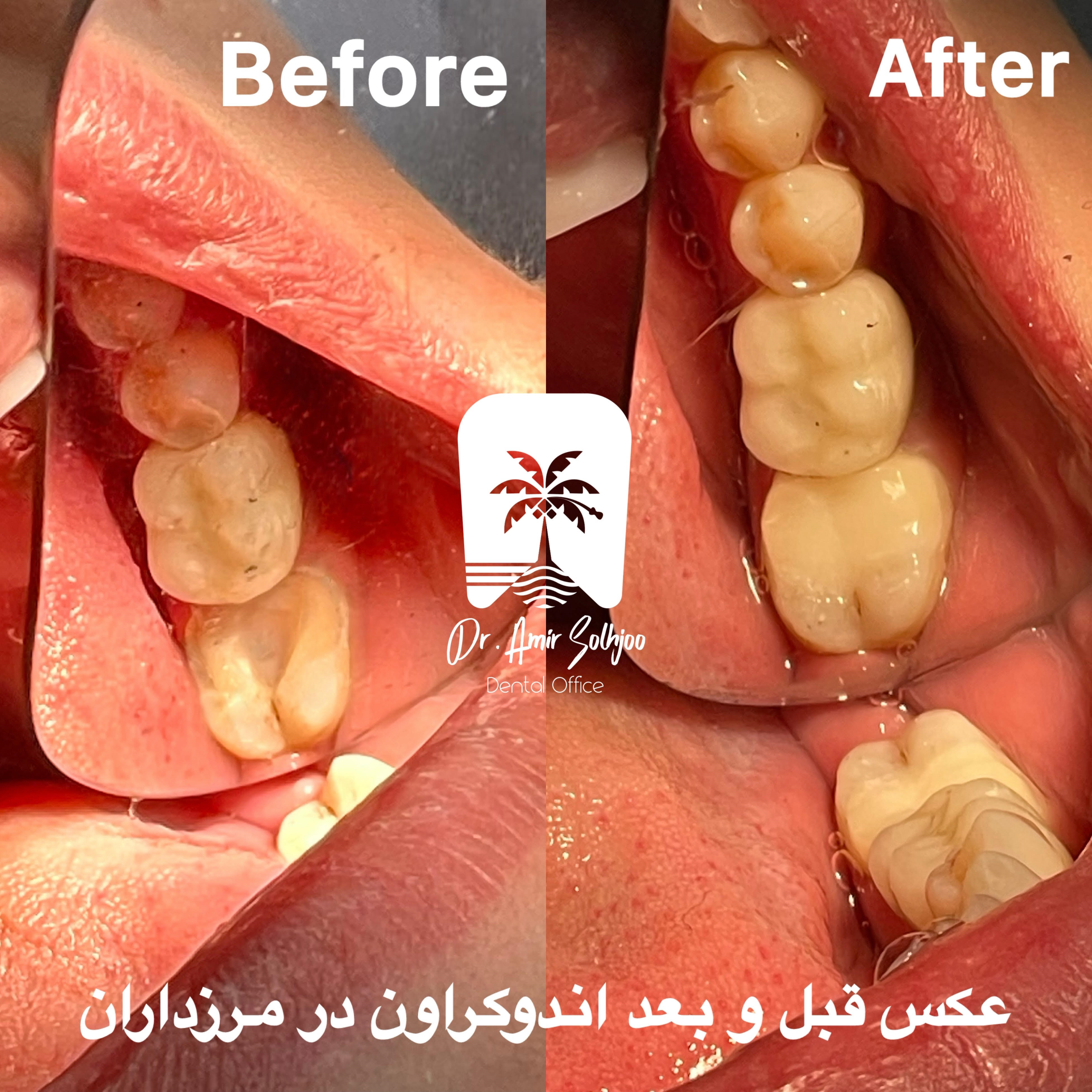 هزینه اندوکراون دندان در تهران
