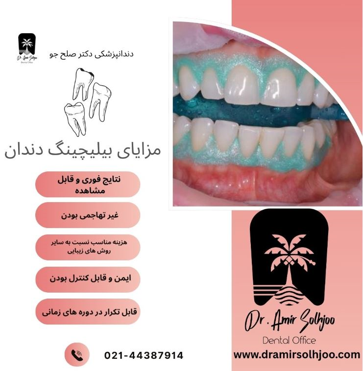 قیمت بلیچینگ دندان ۱۴۰۴